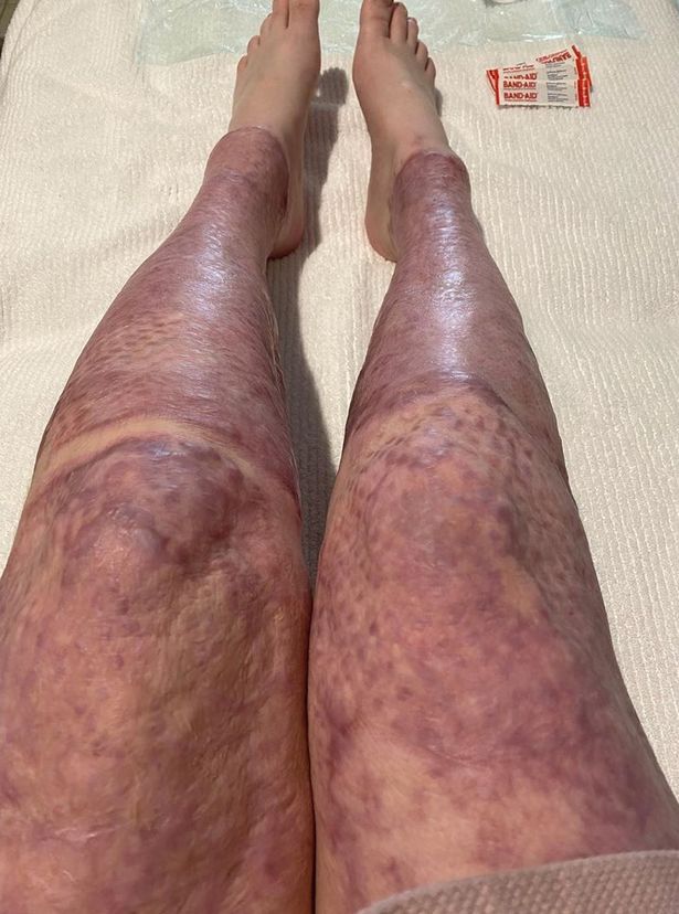 Stephanie suffered horrifying burns to 70% of her body