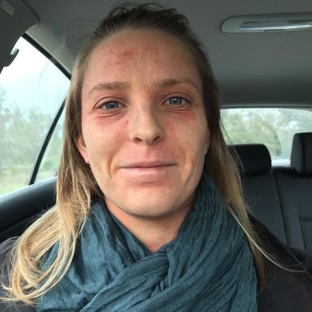 Ellen Vorsselman, who has suffered from eczema since she was a baby