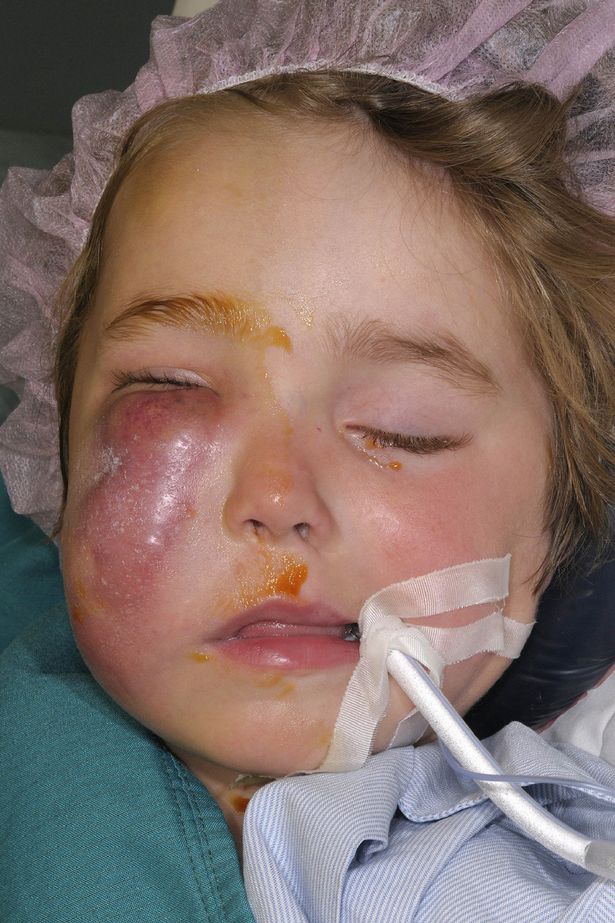 The child was lucky not to have lost his eye and was left with facial paralysis