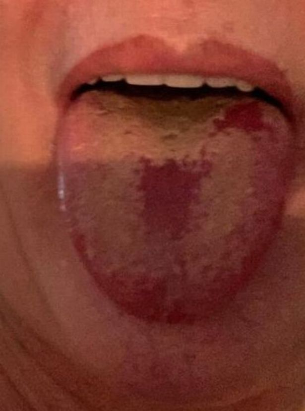 A person with suspected 'Covid tongue'