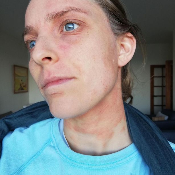 Ellen Vorsselman, who has suffered from eczema since she was a baby