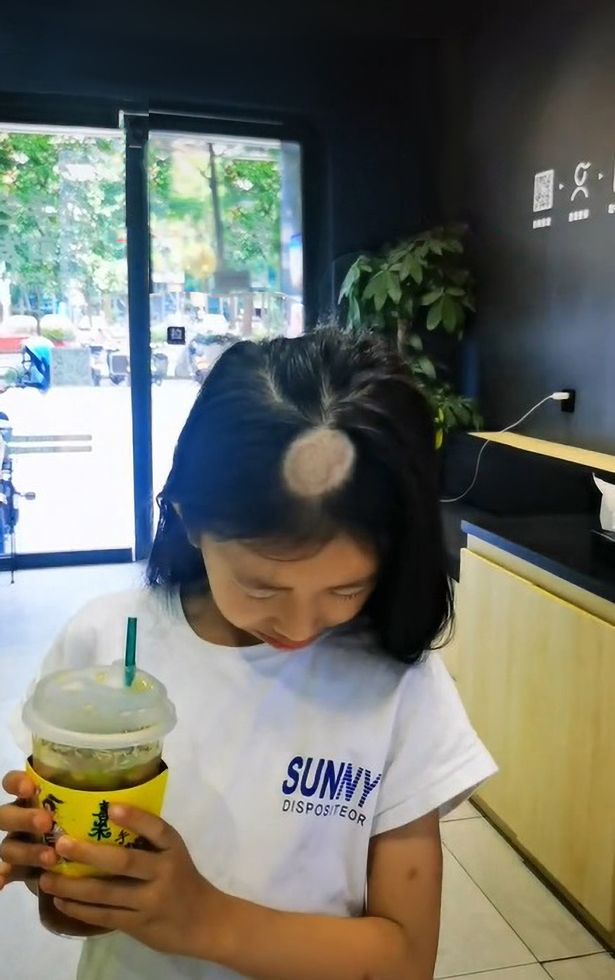 Girl started to lose hair after getting a cat at home in Shenzhen, China