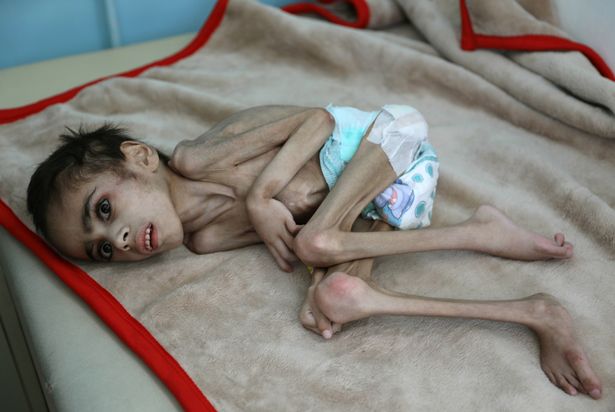 Horrifying pictures of the Yemen conflict show children like Faid Samim, 7, suffering from extreme malnutrition