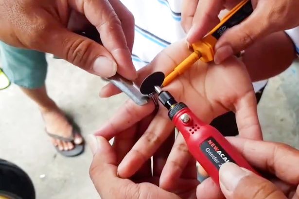 Woman has her diamond ring cut off after it was stuck on her finger.