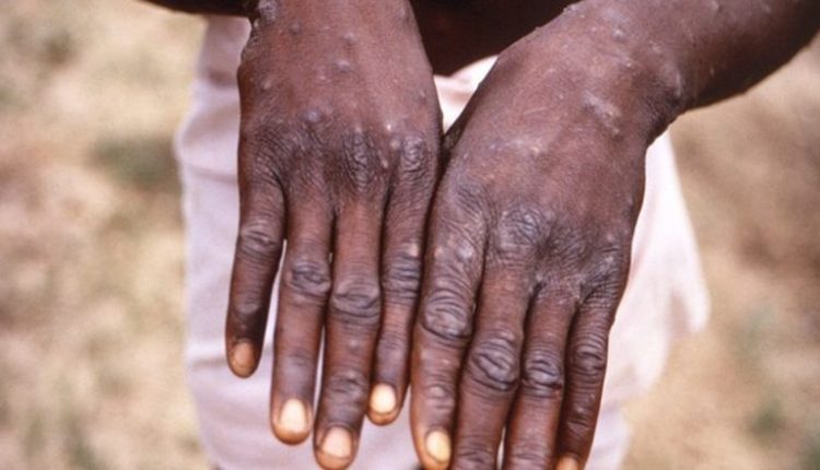 Monkeypox Threat: No Case Reported in Mumbai So Far, Isolation Ward Set Up at Kasturba Hospital for Suspected Cases Says BMC