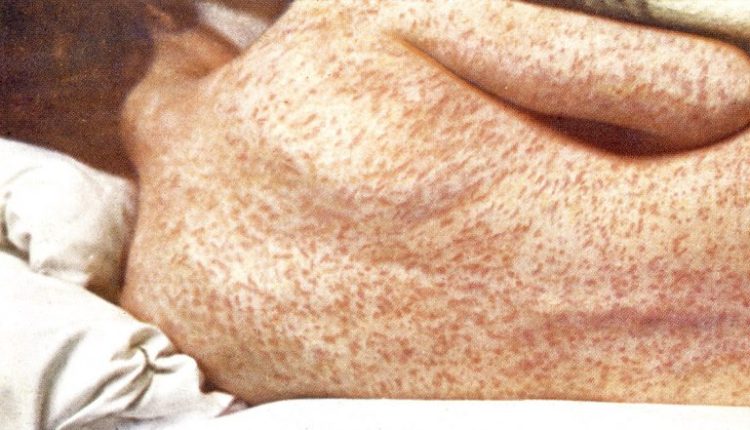 Measles Cases on Rise in Mumbai: What Is Measles? How Does It Spread? Know Causes, Symptoms, Transmission and Treatment of the Viral Infection