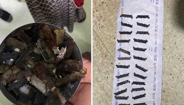 Doctors perform surgery on Rajasthan man, find 56 pieces of razor blades