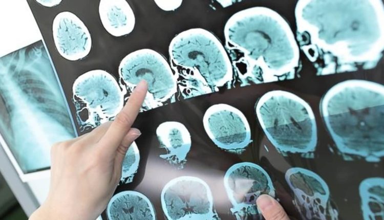 Misdiagnosis leads to over 3.5 lakh deaths every year in US: Study